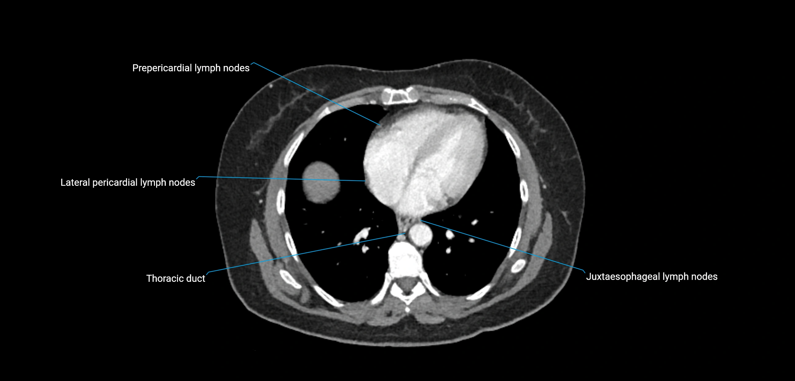 CT ct abdominal lymph nodes  axial cross sectional anatomy  enchanced radiology image -img-00002-00046.webp